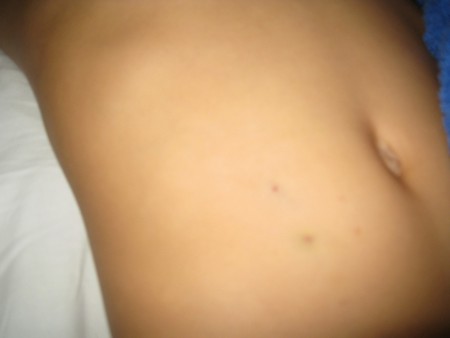 de prikjes in mijn buik